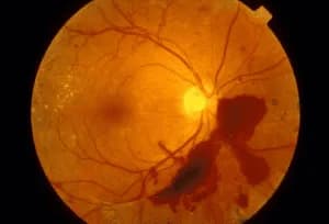 Macular oedema after cataract surgery
