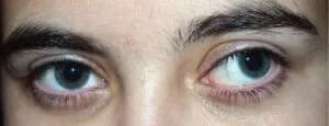 Close-up photo of eyes showing Cyclotropia (rotational misalignment)