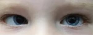 Close-up photo of eyes showing Esotropia (inward turning)