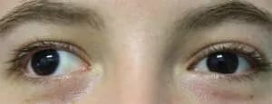 Close-up photo of eyes showing Exotropia (outward turning)