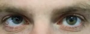 Close-up photo of eyes showing Hypertropia (upward misalignment)