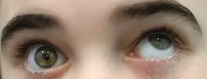 Close-up photo of eyes showing Hypotropia (downward misalignment)