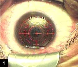 Residual refractive error after cataract surgery