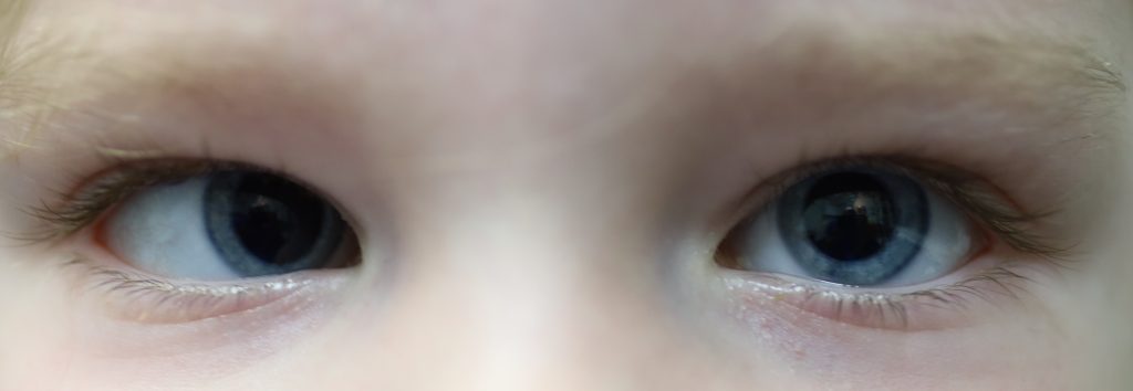 strabismus in children