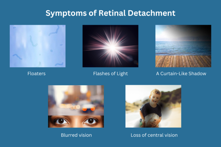 Symptoms of Retinal Detachment