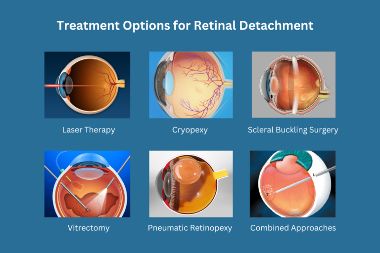 Treatment Options for Retinal Detachment