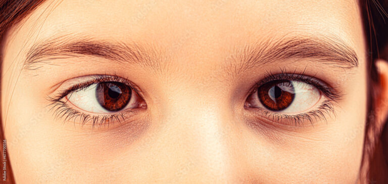 esotropia
