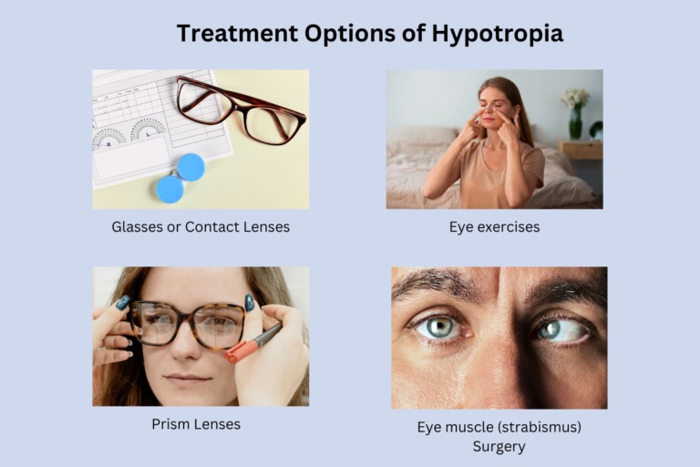 Treatment Options of Hypotropia