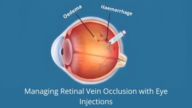 Managing Retinal Vein Occlusion with Eye Injections