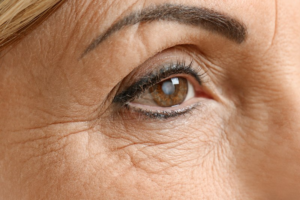 Only the elderly get cataracts