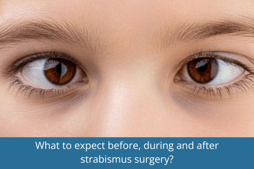 What to expect before, during and after strabismus surgery?
