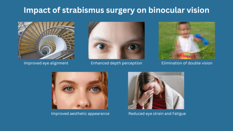 Impact of strabismus surgery on binocular vision