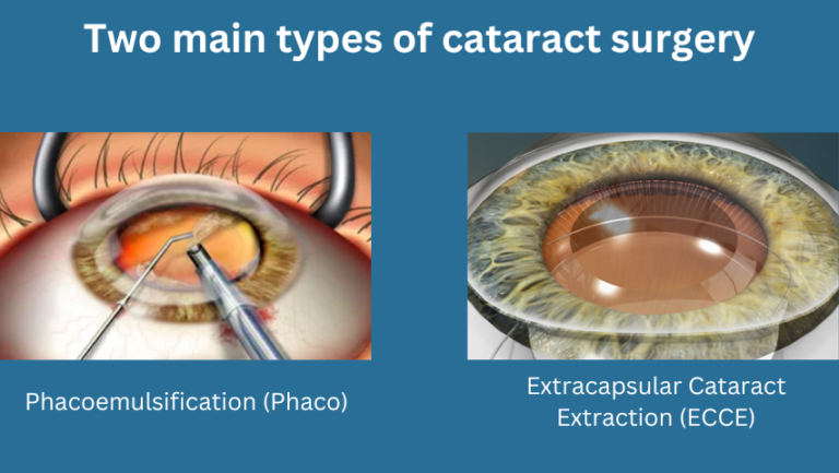 Two main types of cataract surgery