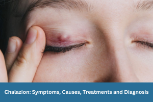 Chalazion Symptoms, Causes, Treatments and Diagnosis