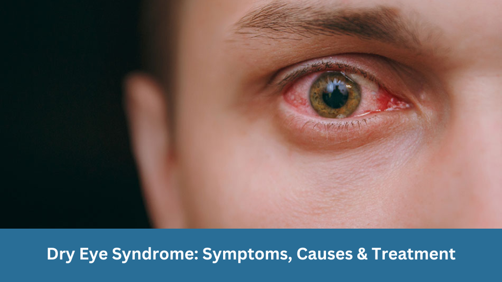 Dry Eye Syndrome Symptoms, Causes & Treatment