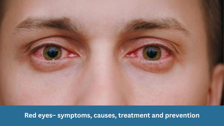 Red eyes– symptoms, causes, treatment and prevention