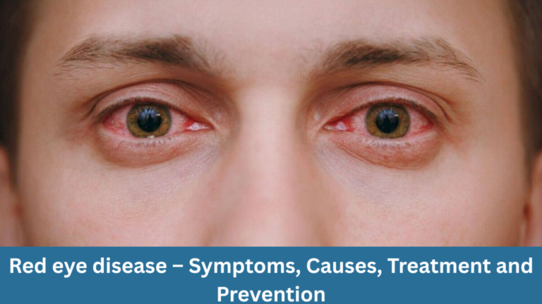 Red eyes– symptoms, causes, treatment and prevention