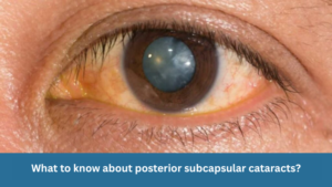 What to know about posterior subcapsular cataracts?
