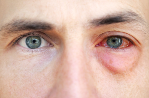 Allergic reactions