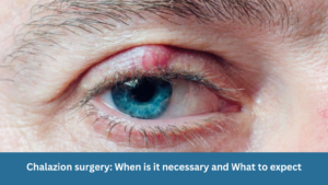 Chalazion surgery: When is it necessary and What to expect