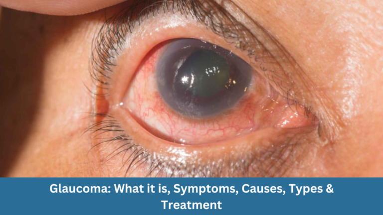 Glaucoma: What it is, Symptoms, Causes, Types & Treatment