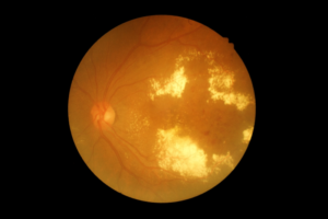 Diabetic Macular Oedema (DMO)
