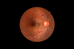 Pre-existing eye conditions