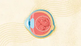 Diabetic retinopathy