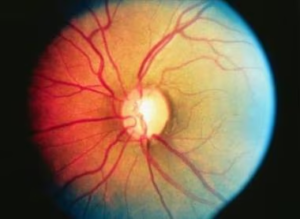 Primary Open-Angle Glaucoma (POAG)
