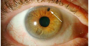 Laser Peripheral Iridotomy (LPI)