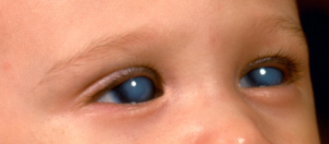 Congenital Glaucoma