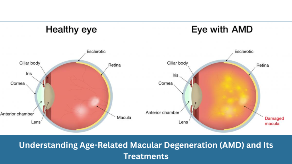 Understanding Age-Related Macular Degeneration (AMD) and Its Treatments
