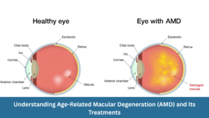 Understanding Age-Related Macular Degeneration (AMD) and Its Treatments