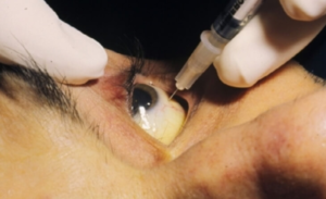 How do intravitreal injections preserve vision?