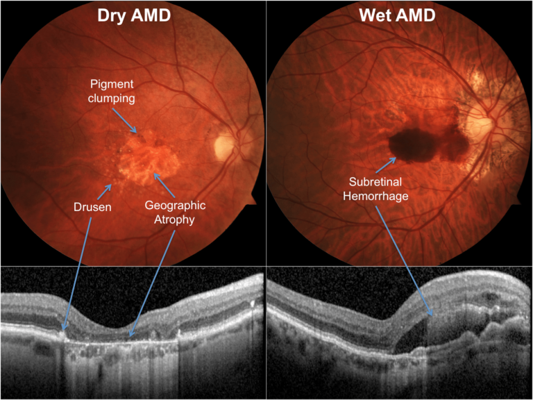 What are the different types of AMD?