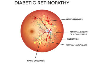 What is diabetic eye disease?