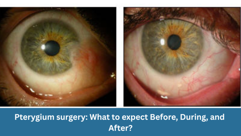 Pterygium surgery: What to expect before, during, and after?