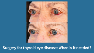 Surgery for thyroid eye disease: When is it needed?