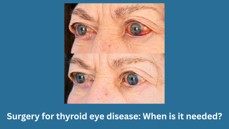Surgery for thyroid eye disease: When is it needed?