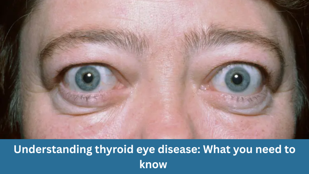 Understanding thyroid eye disease: What you need to know