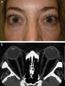 How is thyroid eye disease diagnosed?