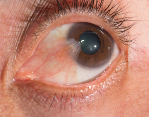 What is a pterygium and why might you need surgery?