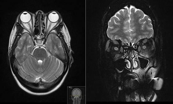 When is surgery needed for thyroid eye disease?