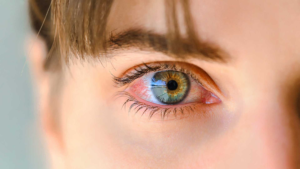 Early symptoms may include: