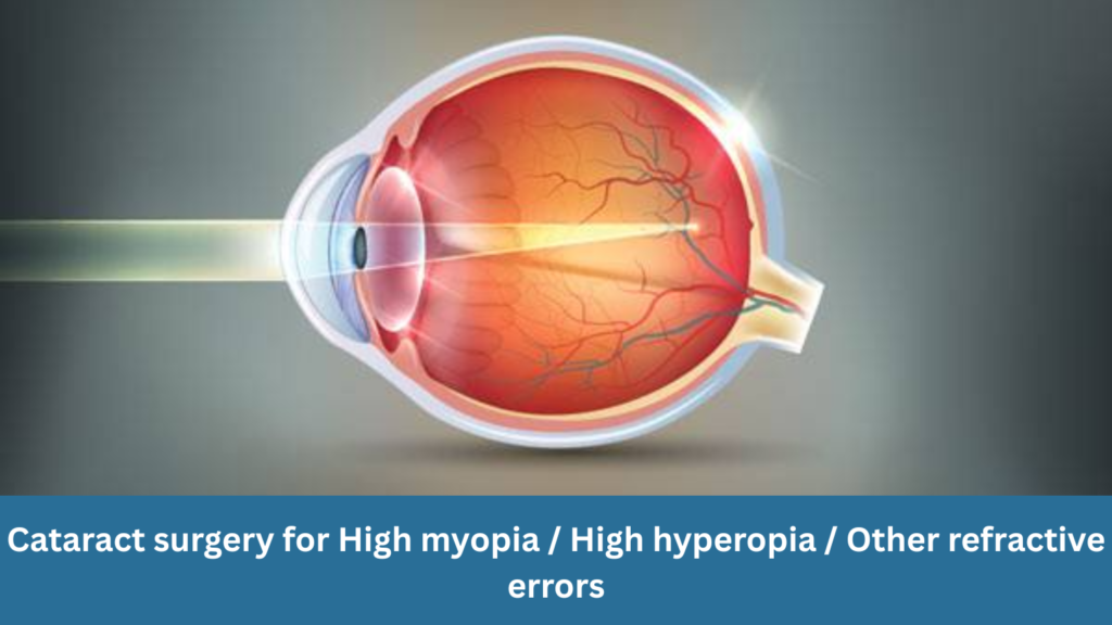 Cataract surgery for high myopia, high hyperopia and other refractive errors