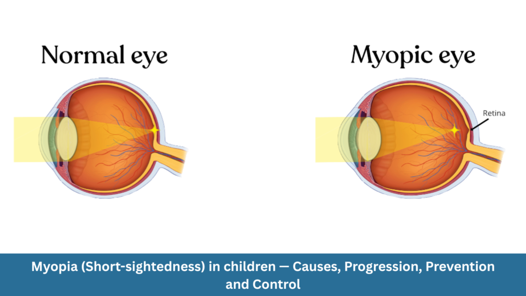 Myopia (Short-sightedness) in Children — Causes, Progression, Prevention and Control