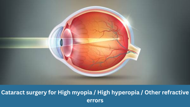 Cataract surgery for high myopia, high hyperopia and other refractive errors