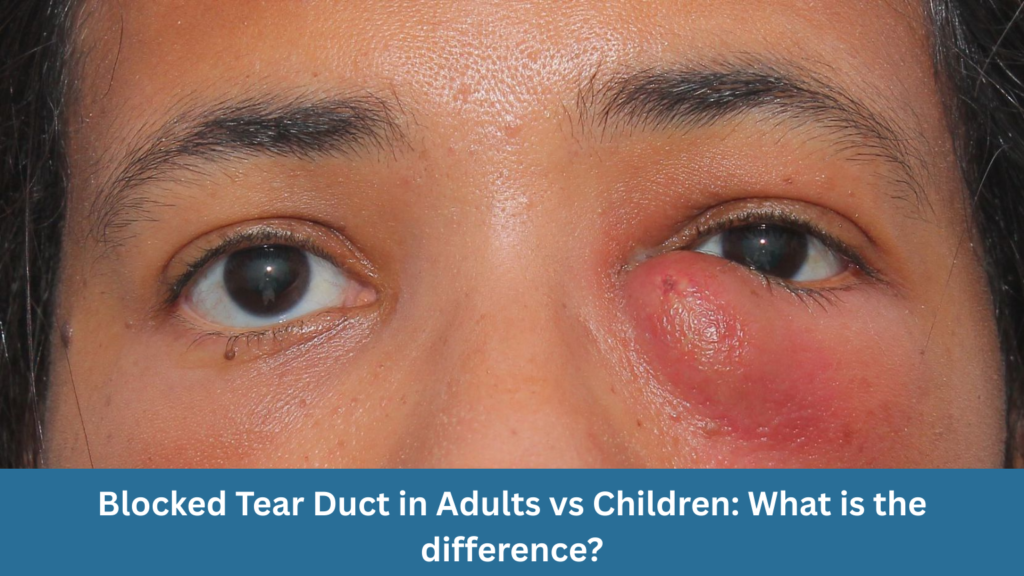 Blocked Tear Duct in Adults vs Children: What is the difference?