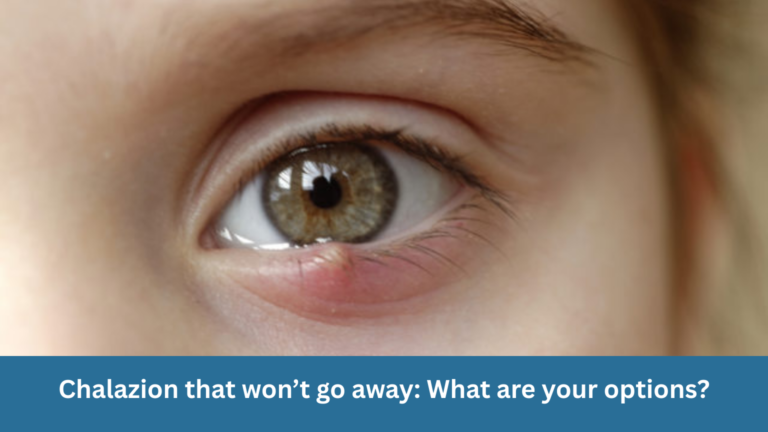 Chalazion that won’t go away: What are your options?