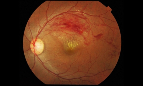 Retinal vein occlusion